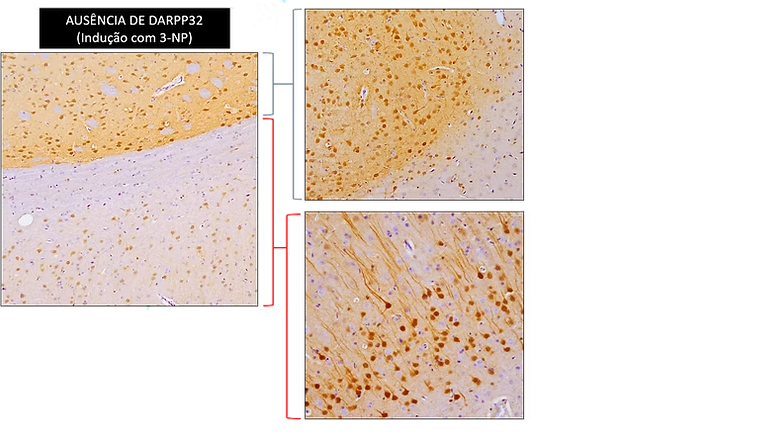 Resultados do transplante de CTIPD - Doença de Huntington